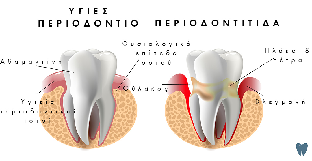 periodontitis_thessaloniki_dimitrakpooulos_dentist-greek_480